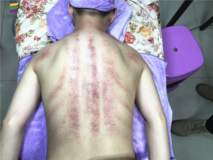 南宁美容学校：美容直播抢先看---背部刮痧