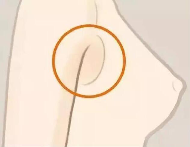 减副乳，瘦手臂一招就解决！