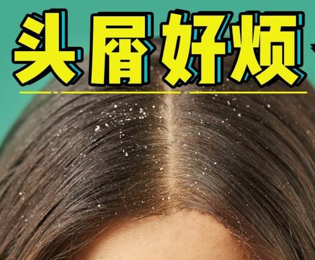 南宁正规美发培训学校分享：冬天如何减少头屑过多？