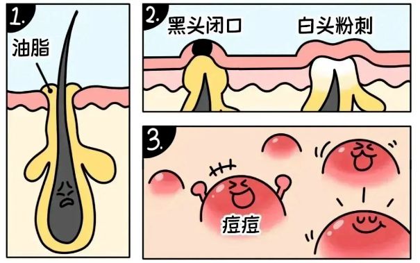 不同部位闭口形成的原因，南宁美容护肤学校解答