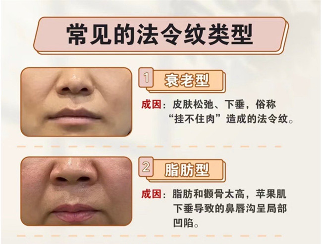 不同类型的法令纹路的产生，南宁专业美容护肤学校